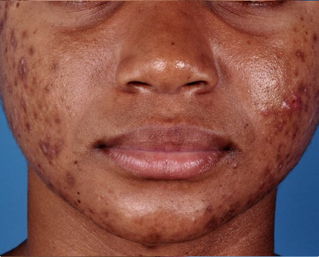 ZO® SKIN HEALTH OIL CONTROL PADS ACNE TREATMENT